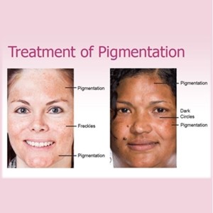 BC - Pigmentation