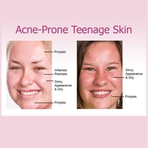 Face Contouring, Mesotherapy including RF skin tightening and slimming